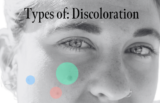 Types of Skin Discoloration & How to Get Rid of Them Fast